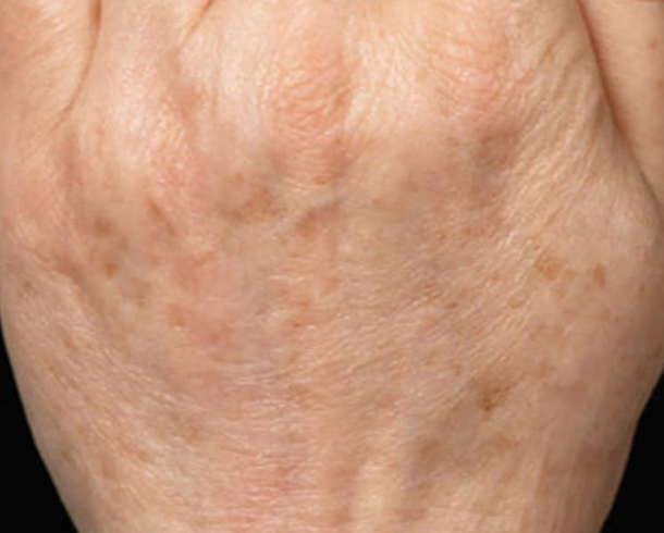 After Wrinkle & Spot Removal